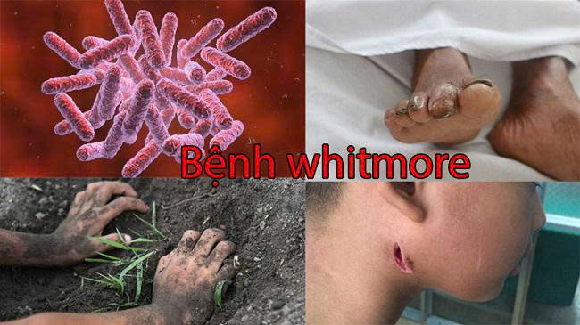 Những điều cần biết về bệnh Whitmore - Hiểu đúng để chủ động phòng bệnh