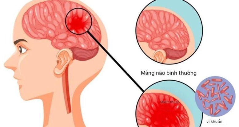 Những điều cần biết về bệnh do não mô cầu