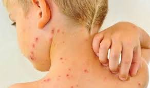 Hà Nội triển khai đồng loạt chiến dịch tiêm bổ sung vắc xin sởi – rubella miễn phí cho trẻ từ 1 đến 5 tuổi sống trên địa bàn Hà Nội tại 584 xã phường