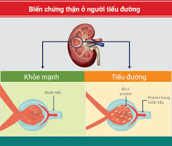 Phòng ngừa và kiểm soát biến chứng mãn tính của bệnh đái tháo đường